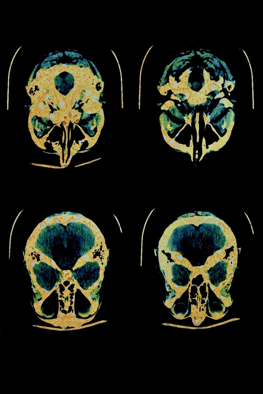 Echoes of Existence: A Radiant Exploration of the Human Skull in Four Dimensions