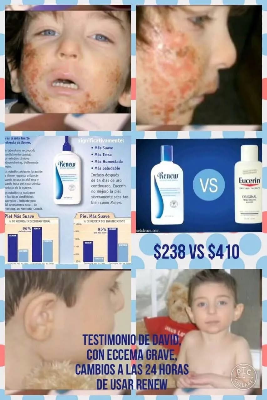 Transformative Healing: A Child's Journey from Eczema to Radiant Skin in Just 24 Hours with Renew