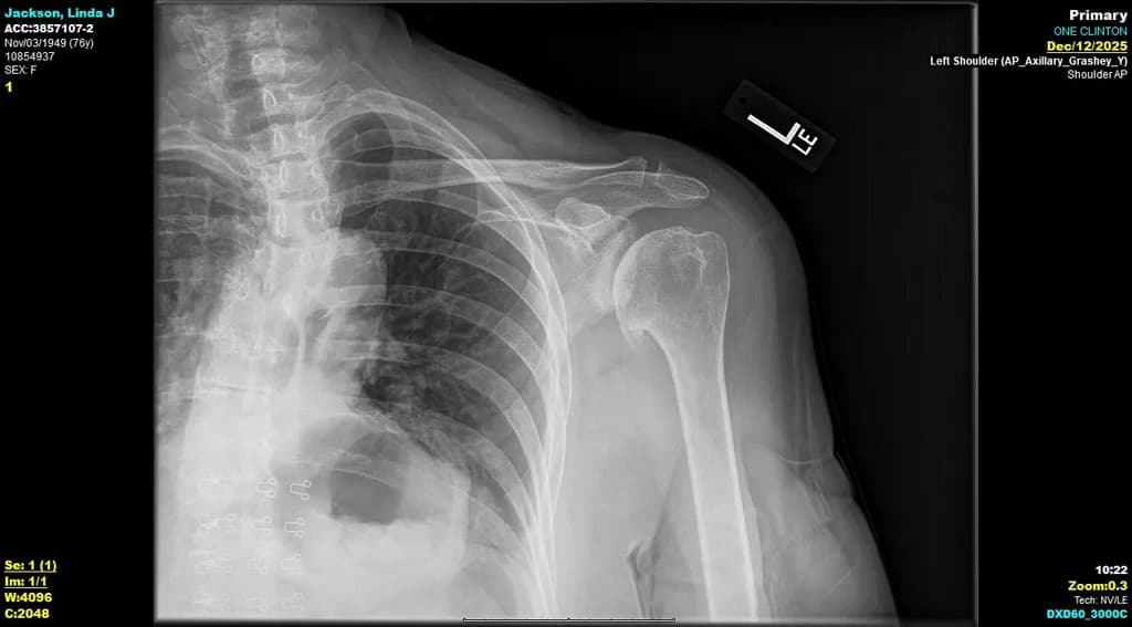 Left Shoulder X-Ray