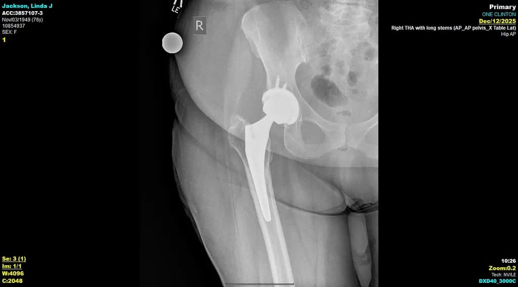 Jackson Linda Hip X-Ray