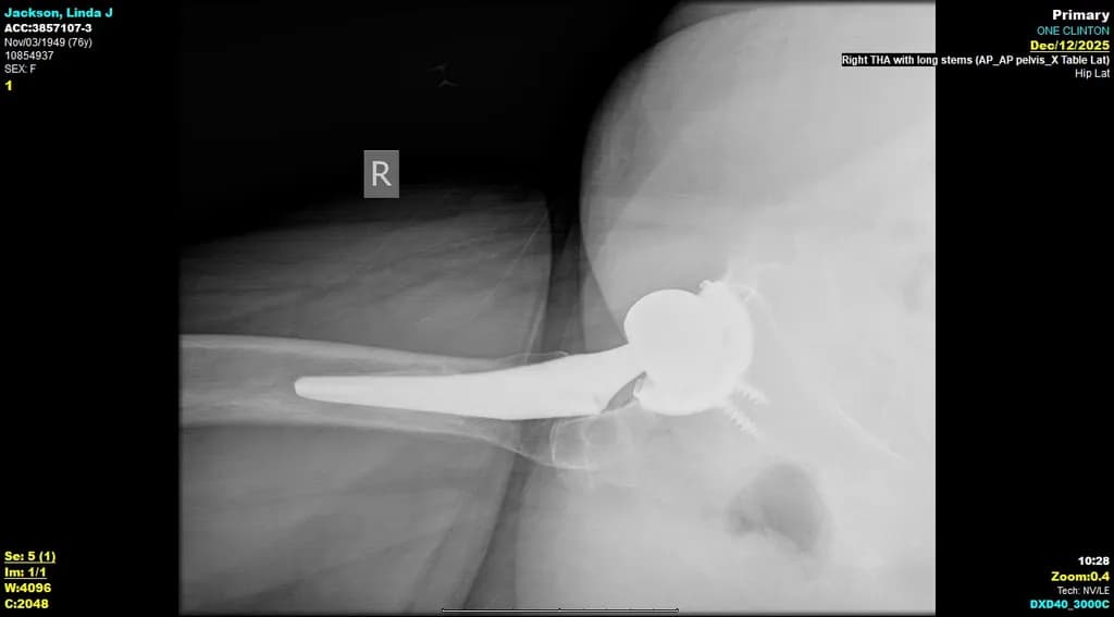 Jackson Linda Hip X-ray