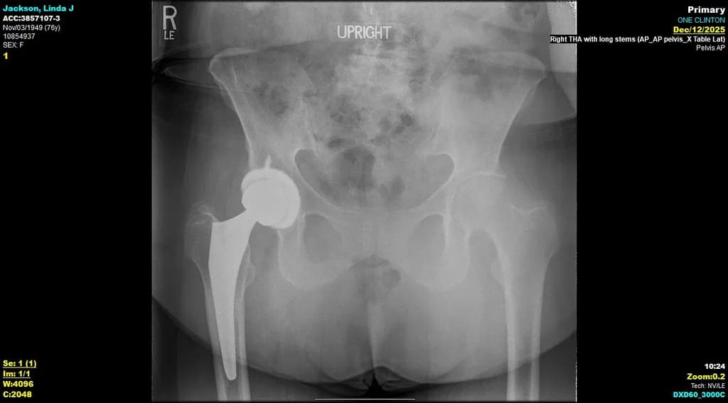 Jackson Linda Hip X-ray