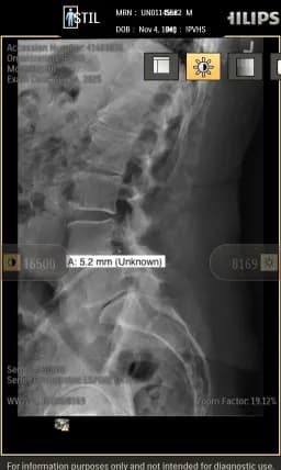Lumbar Spine Radiograph