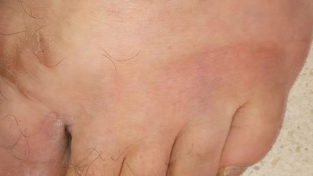 Inflamed Foot Swelling