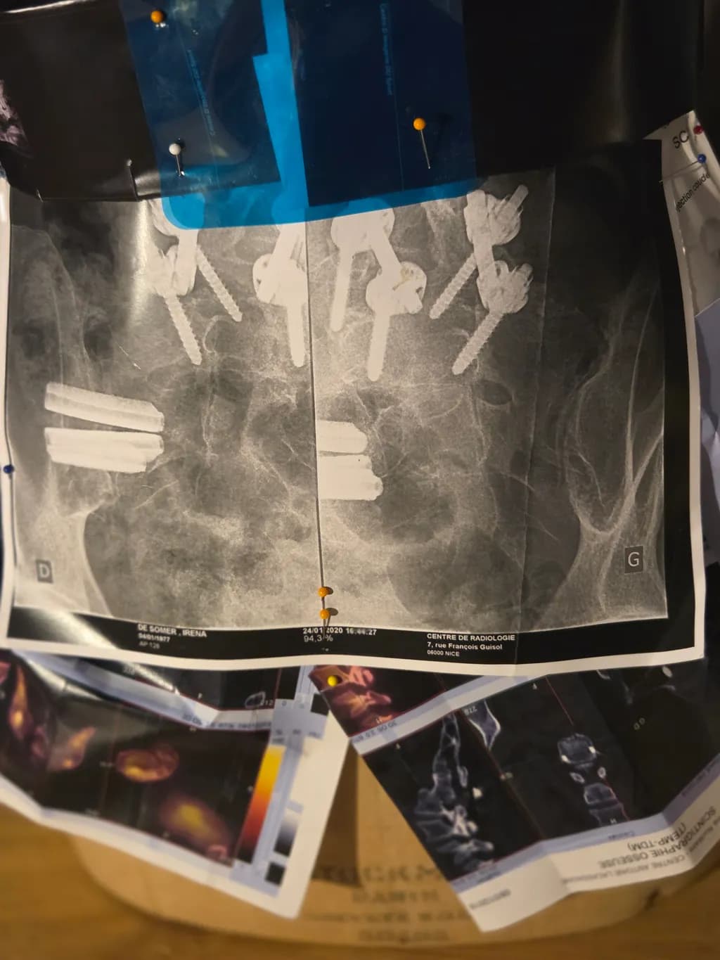 Surgical Fusion Study