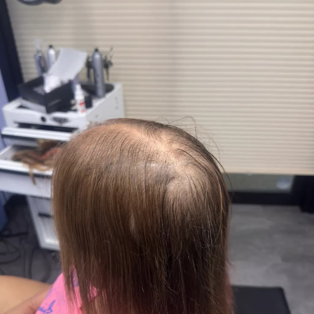 Thinning Hair Pattern