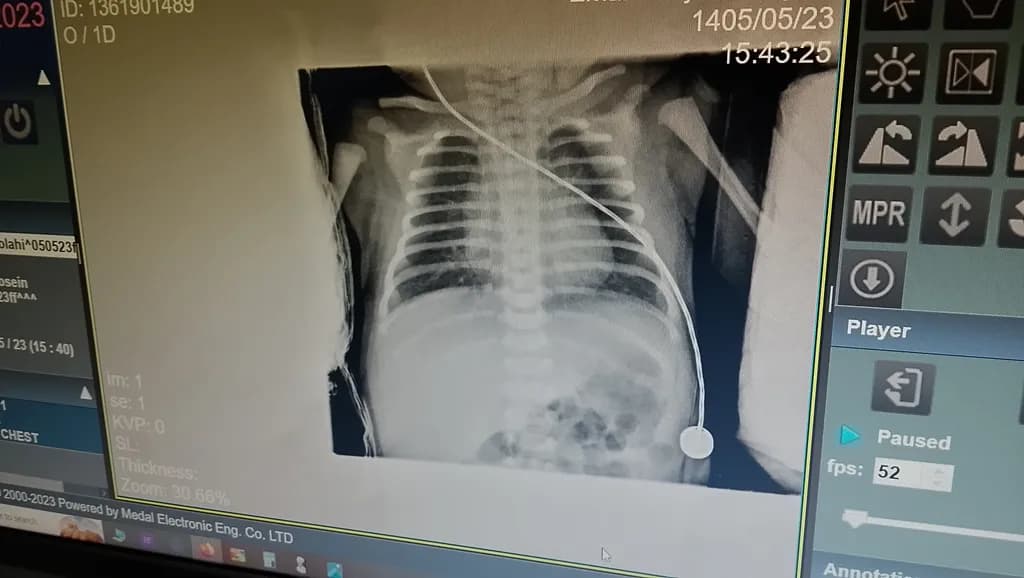 Radiographic Infant Study